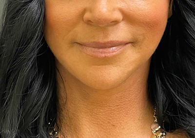 After Image: Neck Lift - front