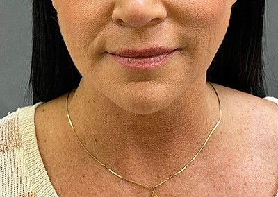 Before Image: Neck Lift - front