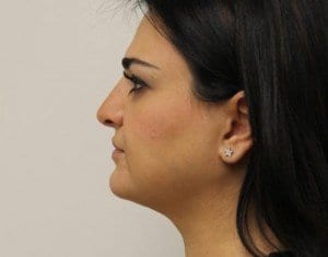 After Image: Neck Liposuction - left-side
