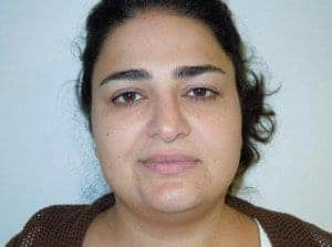 Before Image: Neck Liposuction - front