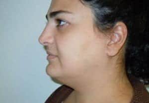 Before Image: Neck Liposuction - left-front-oblique