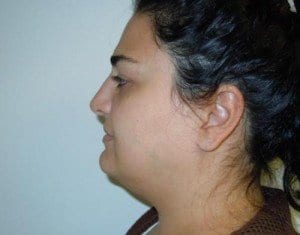 Before Image: Neck Liposuction - left-side