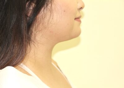 After Image: Neck Liposuction - right-side