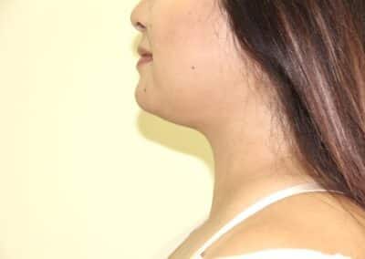 After Image: Neck Liposuction - left-side