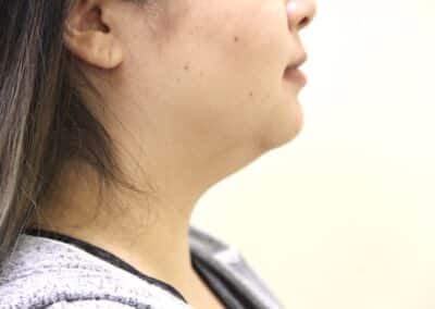Before Image: Neck Liposuction - right-side