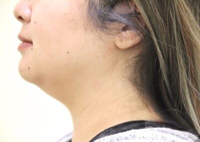 Before Image: Neck Liposuction - left-side