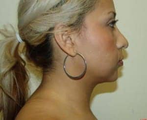 After Image: Neck Liposuction - right-side