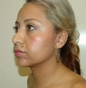 After Image: Neck Liposuction - left-side