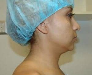 Before Image: Neck Liposuction - right-side