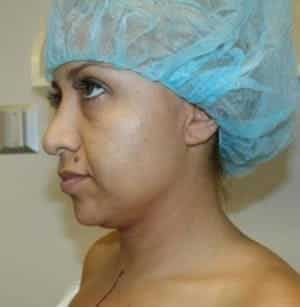 Before Image: Neck Liposuction - left-side