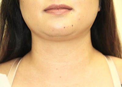 After Image: Neck Liposuction - front