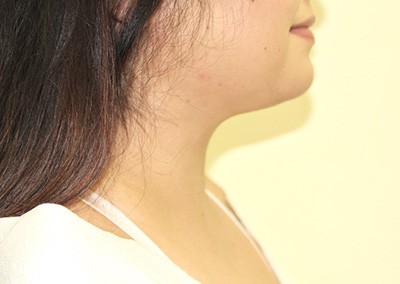 After Image: Neck Liposuction - right-side