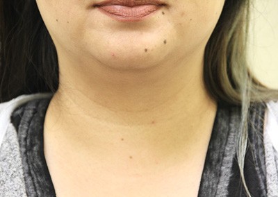 Before Image: Neck Liposuction - front