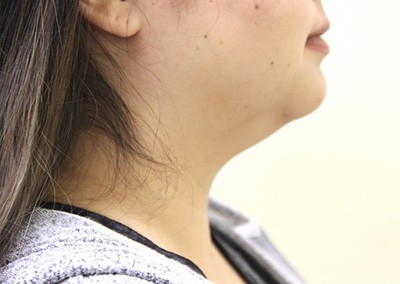 Before Image: Neck Liposuction - right-side