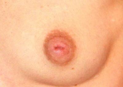 Before Image: Nipple Surgery - front