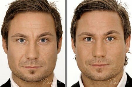 Before and After Image: RestyLane - front