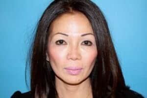 After Image: Revision Rhinoplasty - front
