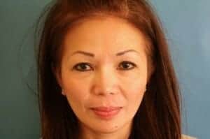 Before Image: Revision Rhinoplasty - front
