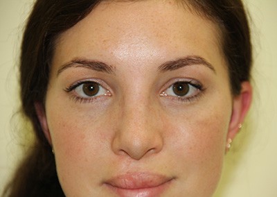 Before Image: Revision Rhinoplasty - front