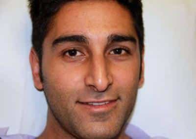 Before Image: Rhinoplasty For Men - front