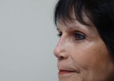 After Image: Rhinoplasty For Men - left-front-oblique