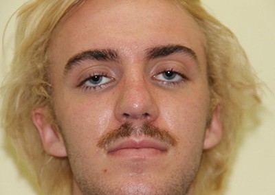 After Image: Rhinoplasty For Men - front