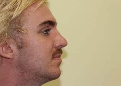After Image: Rhinoplasty For Men - right-side