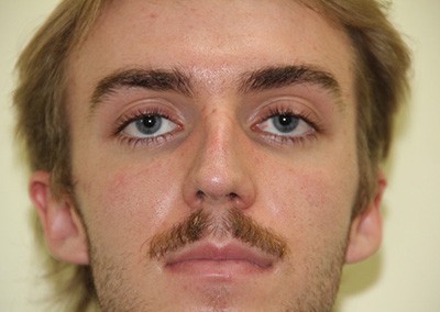 Before Image: Rhinoplasty For Men - front