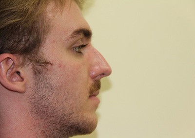 Before Image: Rhinoplasty For Men - right-side