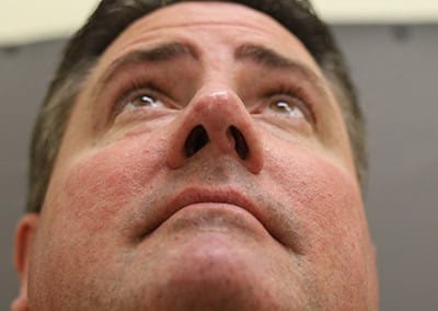 After Image: Rhinoplasty For Men - front