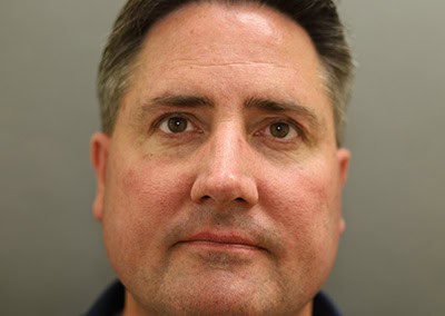 Before Image: Rhinoplasty For Men - front