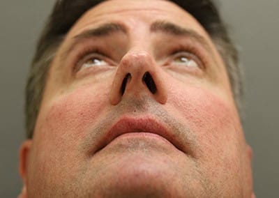 Before Image: Rhinoplasty For Men - front