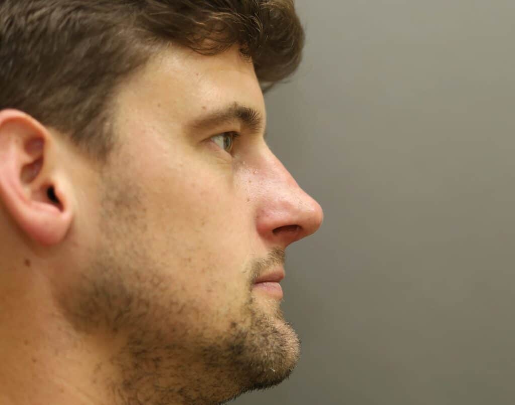 After Image: Rhinoplasty For Men - right-side