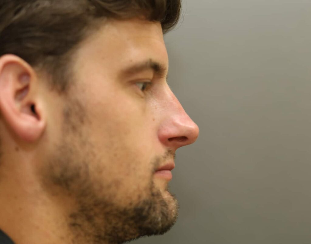Before Image: Rhinoplasty For Men - right-side