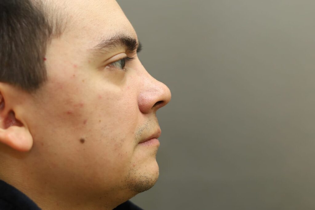 After Image: Rhinoplasty For Men - right-side