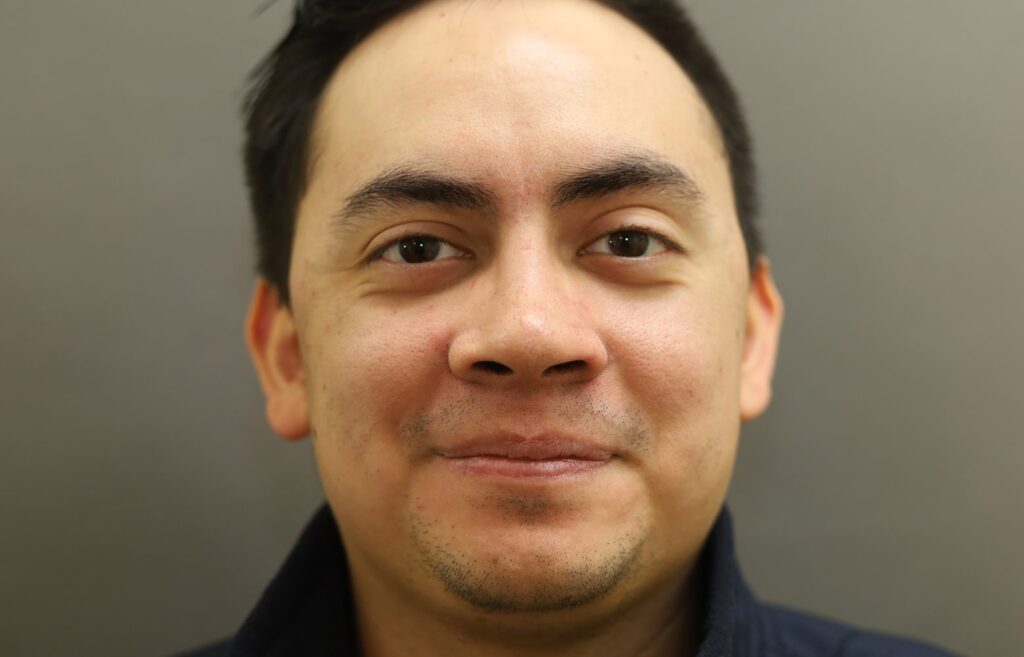 Before Image: Rhinoplasty For Men - front