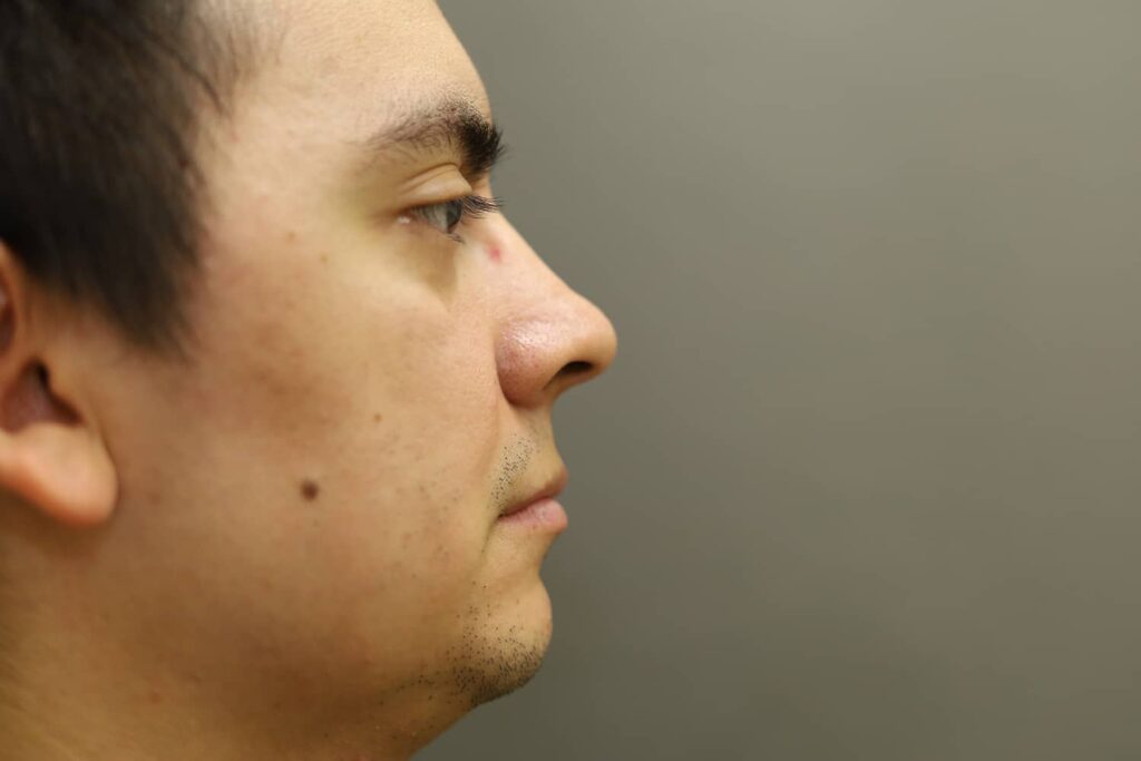 Before Image: Rhinoplasty For Men - right-side
