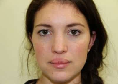 Before Image: Rhinoplasty For Men - front