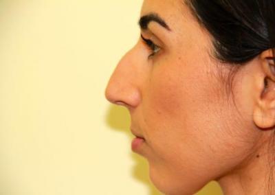Before Image: Rhinoplasty For Men - left-side