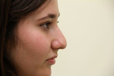 Before Image: Rhinoplasty For Men - right-front-oblique