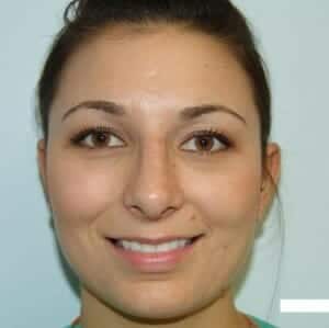 Before Image: Rhinoplasty For Men - front