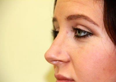 After Image: Rhinoplasty For Men - left-side