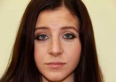 Before Image: Rhinoplasty For Men - front