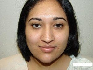 Before Image: Rhinoplasty For Men - front