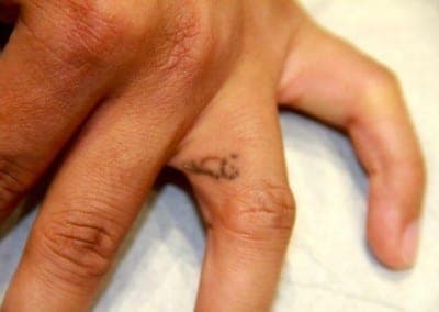 Before Image: Tattoo Removal - front