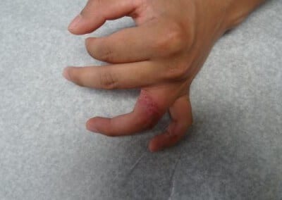 Before Image: Tattoo Removal - front