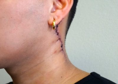 After Image: Tattoo Removal - left-front-oblique