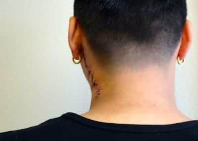 After Image: Tattoo Removal - back