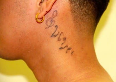 Before Image: Tattoo Removal - left-front-oblique