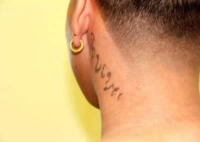 Before Image: Tattoo Removal - back